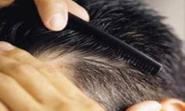 موهایتان می ریزد؟ شاید از تیروییدتان است!